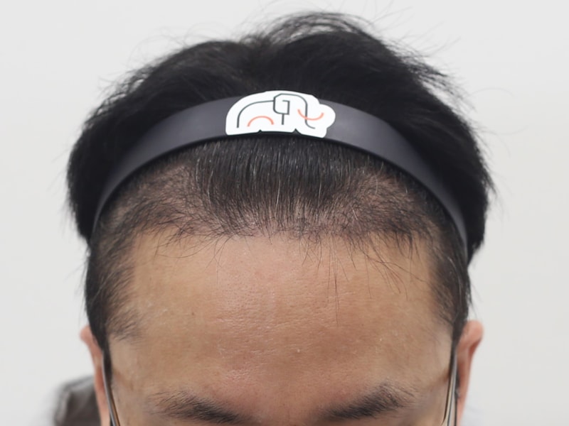 모발 이식 120일째 경과 입니다.