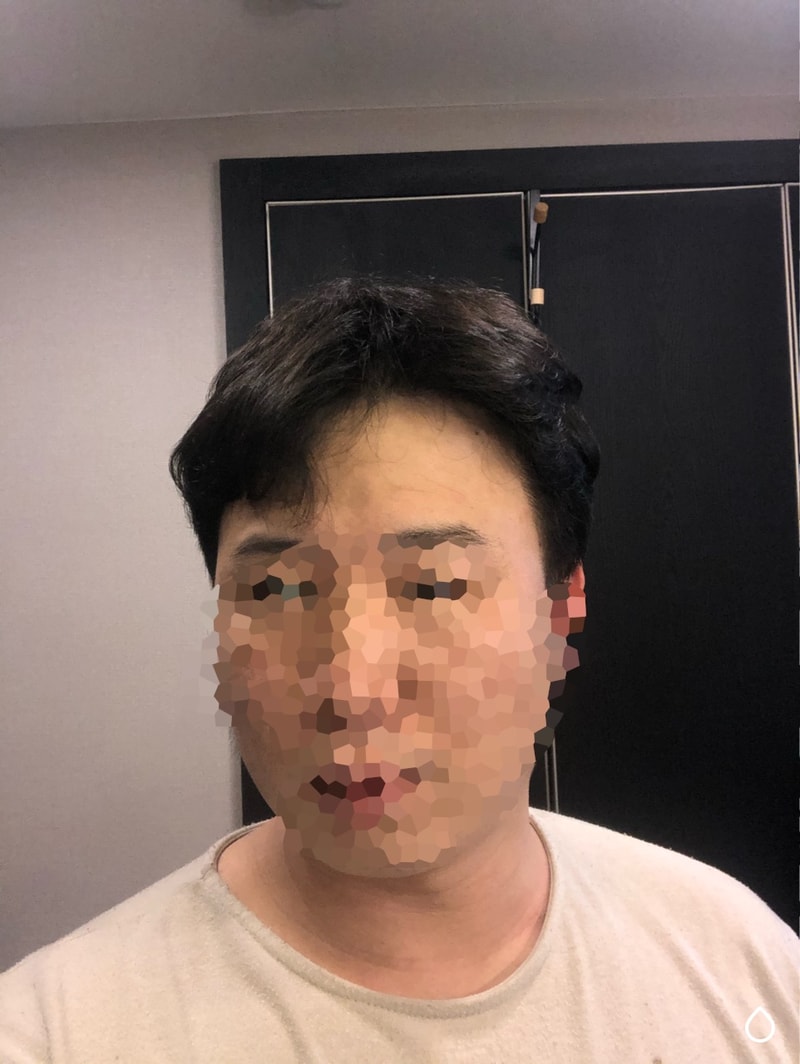 모발이식 약 8개월경과