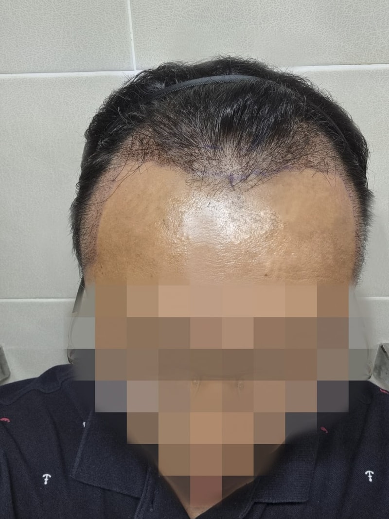 수술 후 정면.jpg