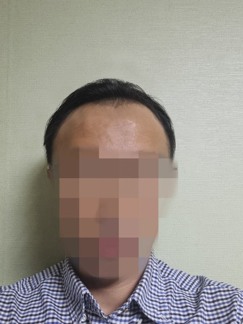 수술 전 정면.jpg