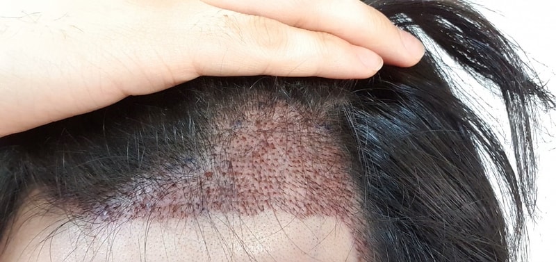 어제 수술하고 후기올립니다