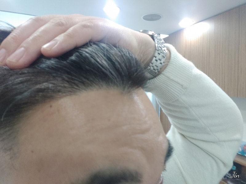 이식 일년차. 모발이식 졸업합니다