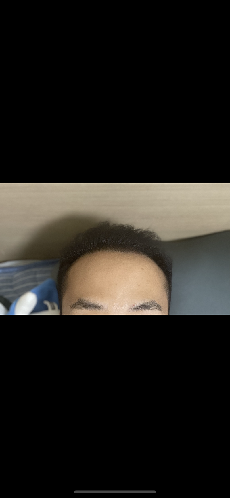 모발이식 수술 후기 9개월차