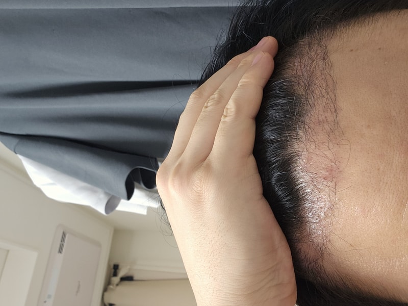 뉴헤어 1400모낭 절개 후기