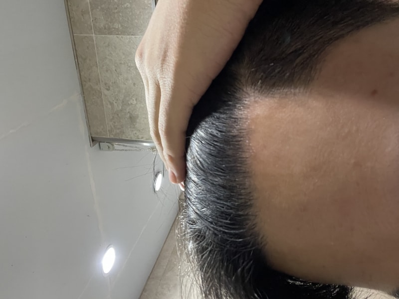 3200모 비절개 1년 후기입니다