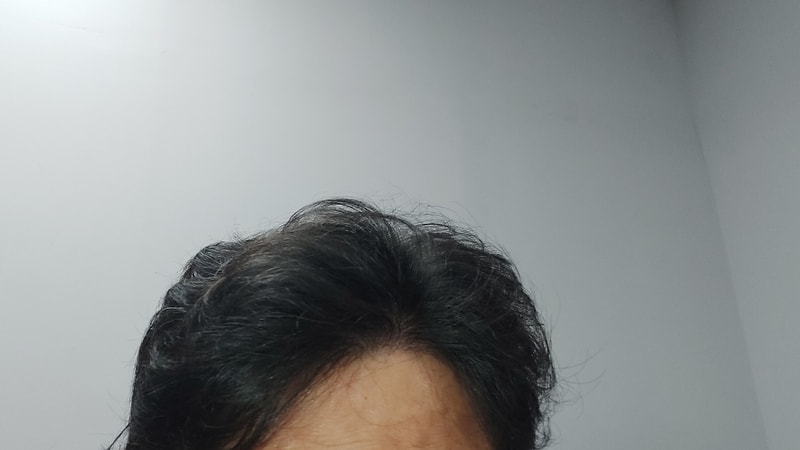 모발이식 벌써 2년반 지났네요.