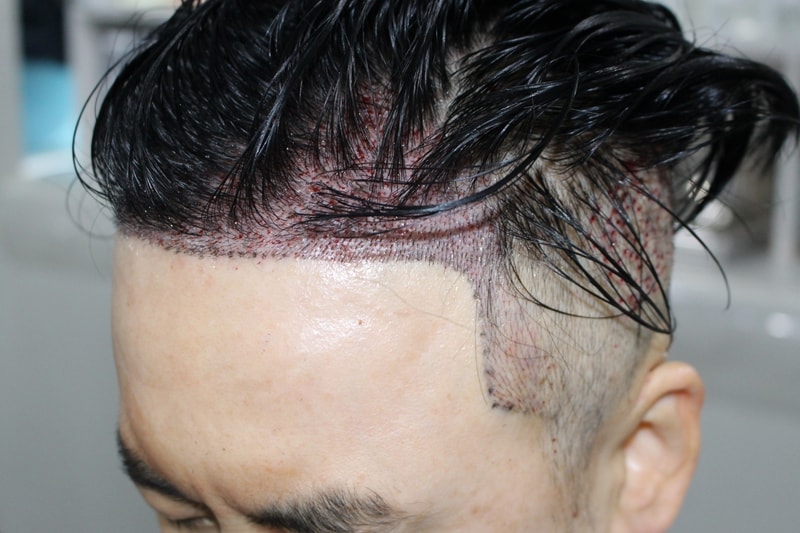 After the first round of Turkey, the second Modaol Hair Transplant Yangyu-gun director's density reinforcement and temple transplantation review