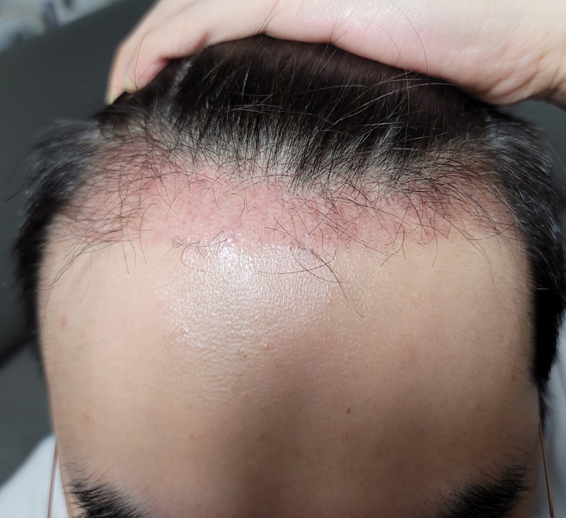 It's been 65 days since my hair transplant