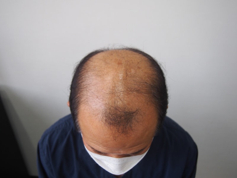 30년 겪은 탈모 극븍하려 합니다