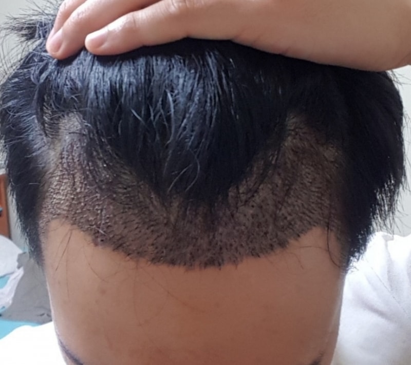 [Mo & Bless] I'm sharing the status of the first day of surgery.