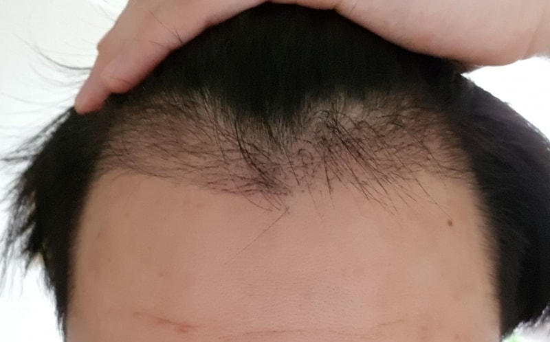 비절개 M자 수술후  약110일 경과