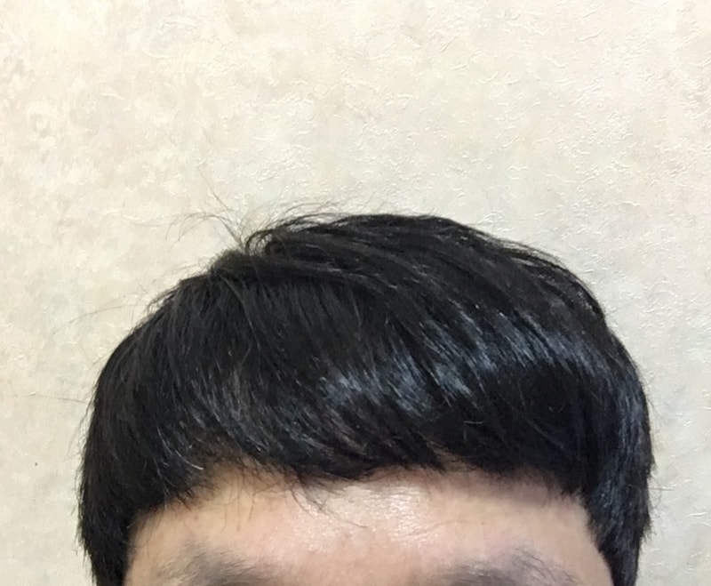 모재성 비절개 1700모낭 이식 1년 경과 평가 부탁드립니다.