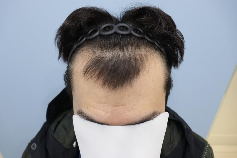 모발이식 1년경과 후기 남깁니다~