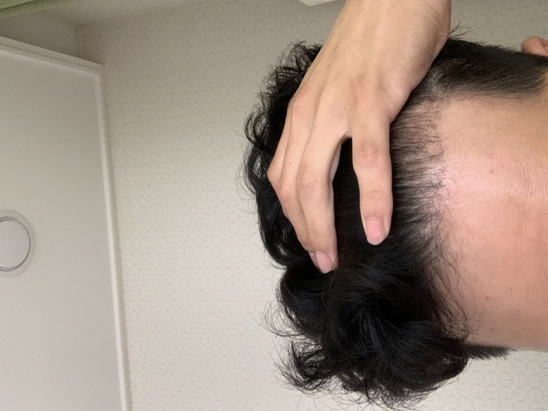 비절개 3000모 100일 경과
