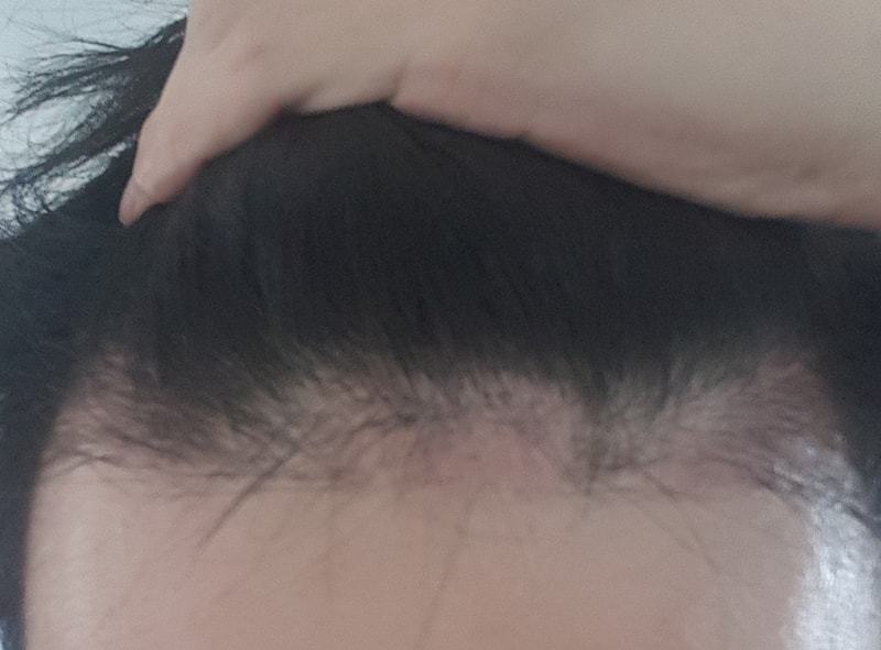 3000모 비절개 모발이식 3개월차