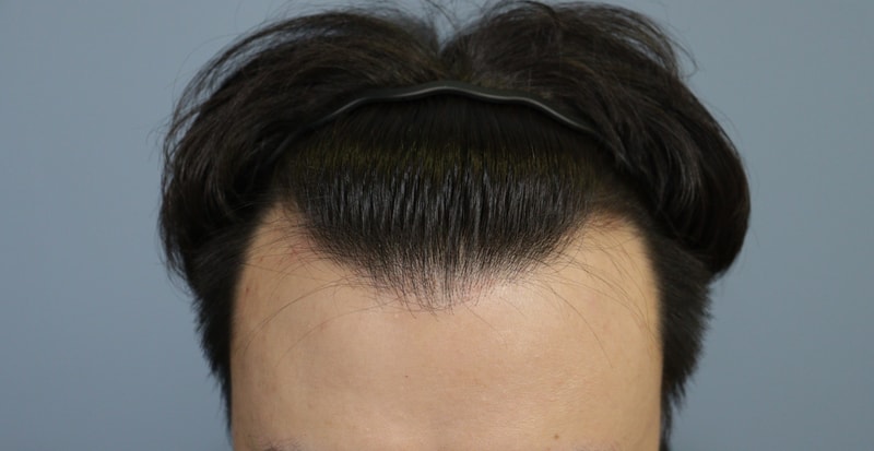 광주압구정모비앙의원 모발이식10일차 경과후기
