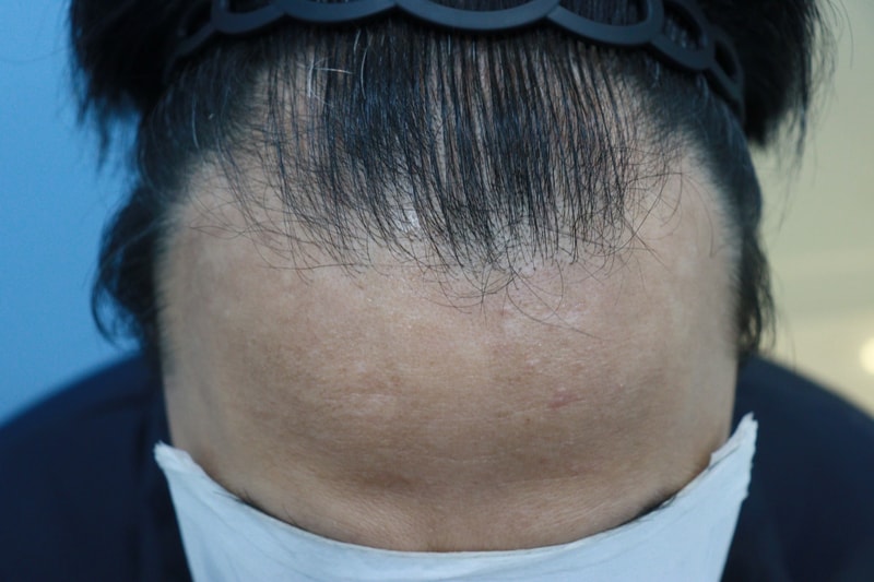 광주압구정모비앙 의원 1년 경과후기