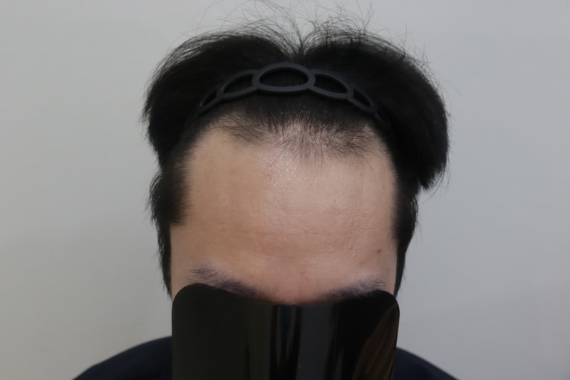 광주 압구정 모비앙의원 모발이식 10일차 경과후기
