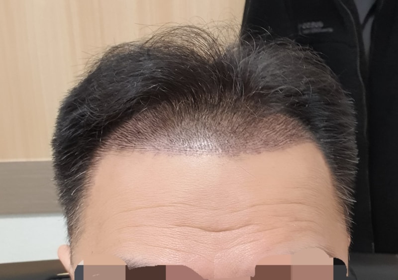 비절개 14일차 입니다.