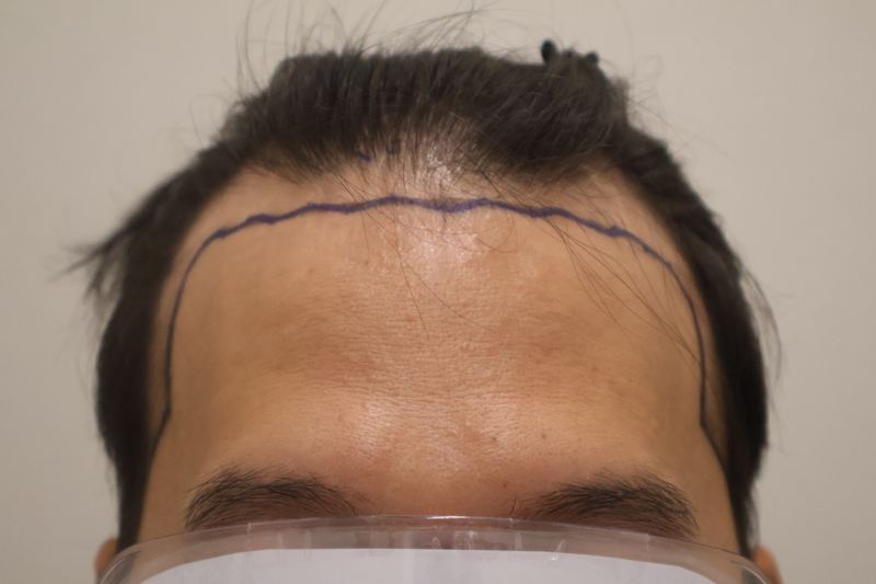 Day 10 of Dongtan Hairro Clinic Hair Transplantation