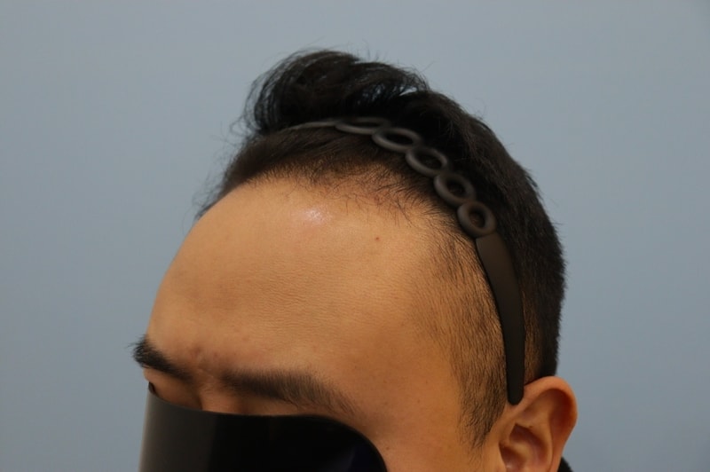광주 압구정 모비앙 의원 모발이식 10개월 경과 후기