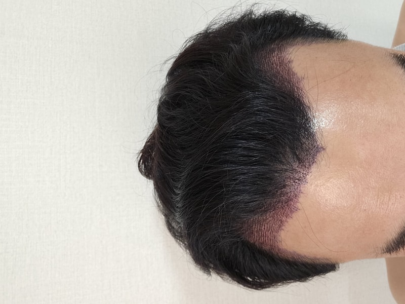 [모먼트의원] 비절개히든컷 2일차 후기입니다.