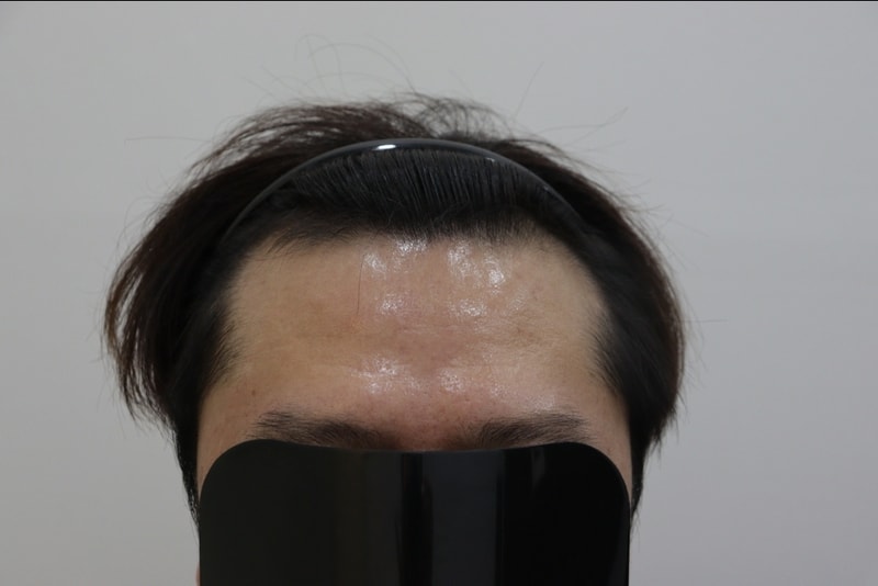 광주 압구정모비앙의원 모발이식 10개월경과후기