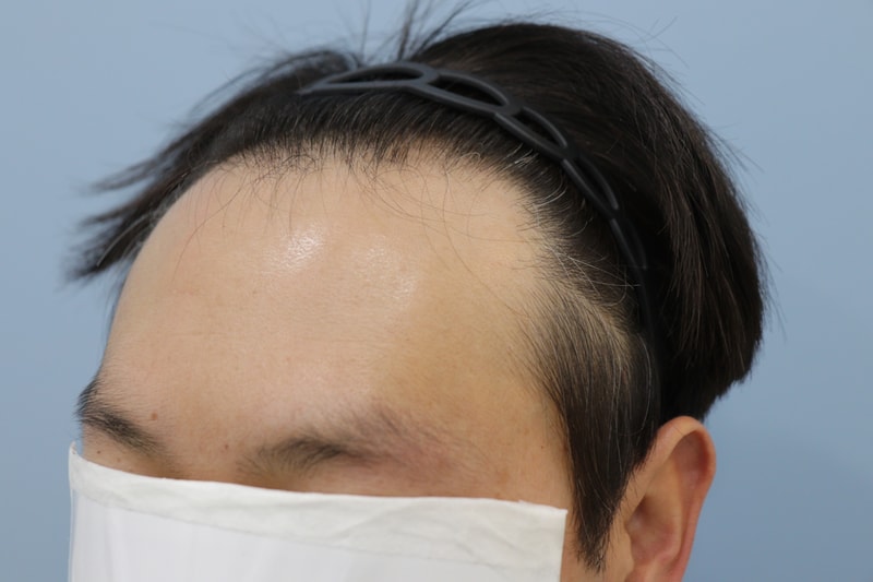 광주압구정모비앙 모발이식 10개월 경과 후기