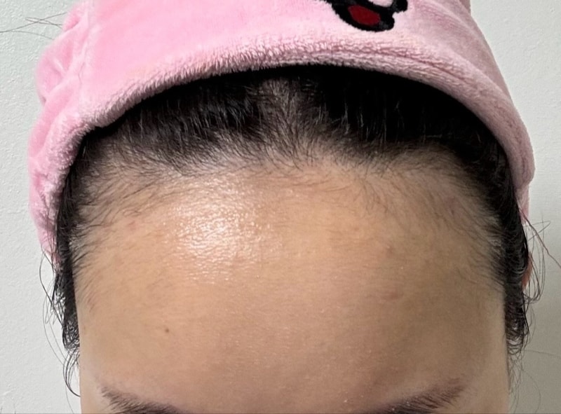 너무너무 기대되는 헤어라인 모발이식 2일째