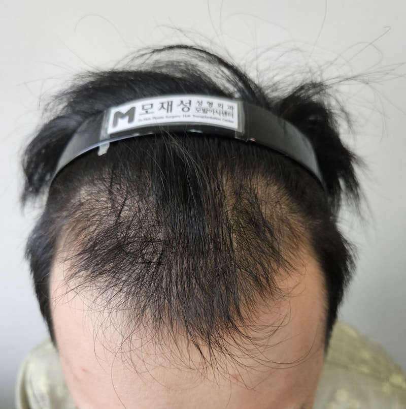 重度のM字と少しの頭頂部薄毛2200毛包 非切開移植