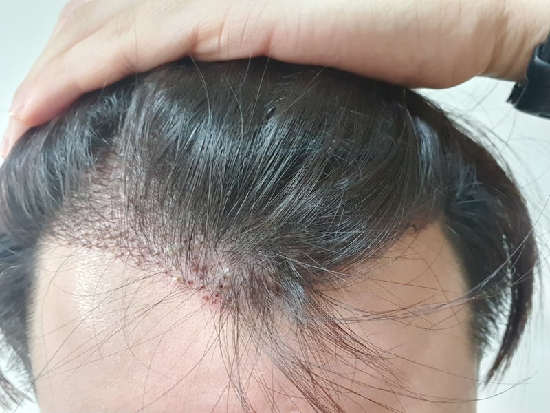 재수술하고 3일차입니다