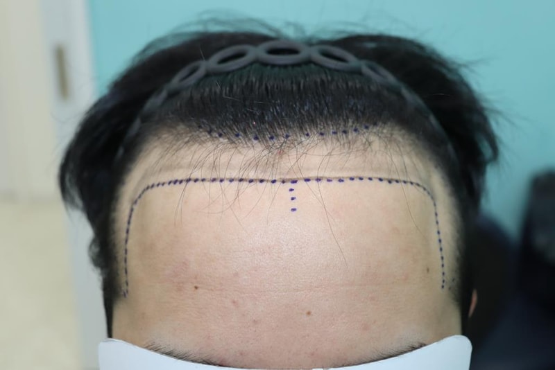 광주 압구정모비앙의원 6개월경과 후기