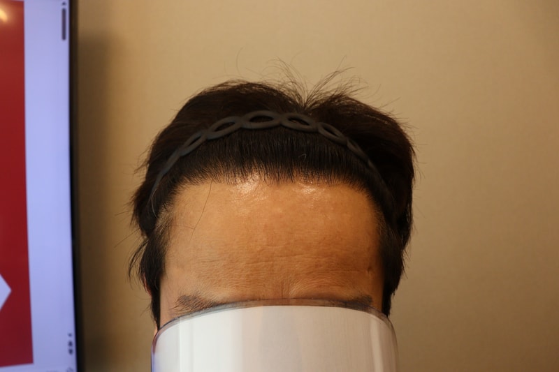 대구 압구정 모비앙 수술 후기