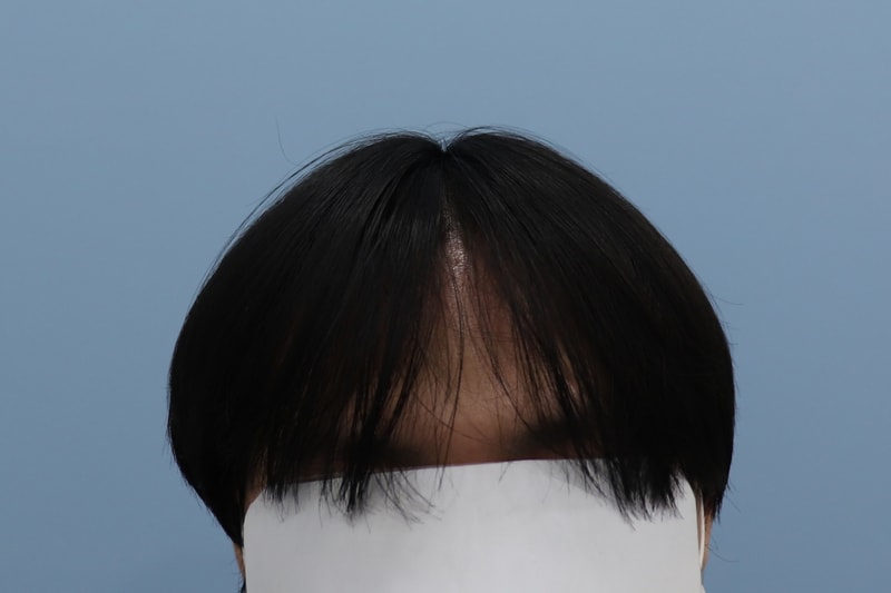 절개 모발이식 1년 후기입니다!