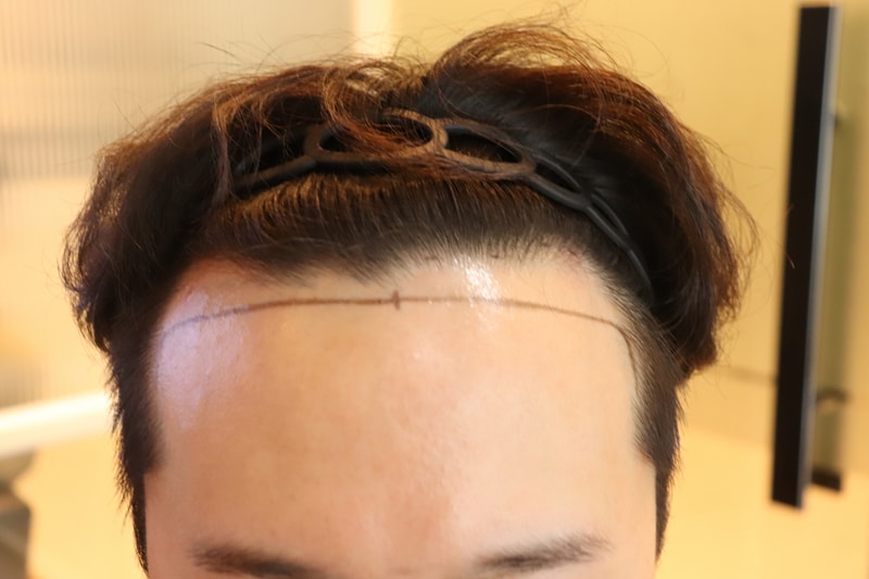 Gwangju Apgujeong Mobiang Hair Transplantation 2 Weeks and Late Periods