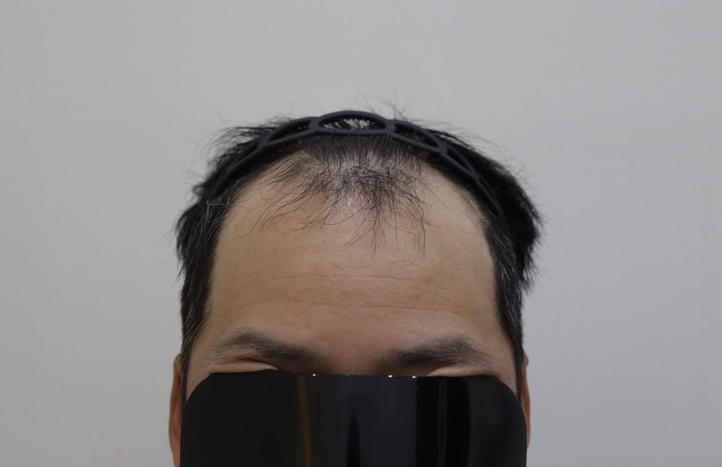 광주압구정모비앙의원 모발이식 10개월 경과후기