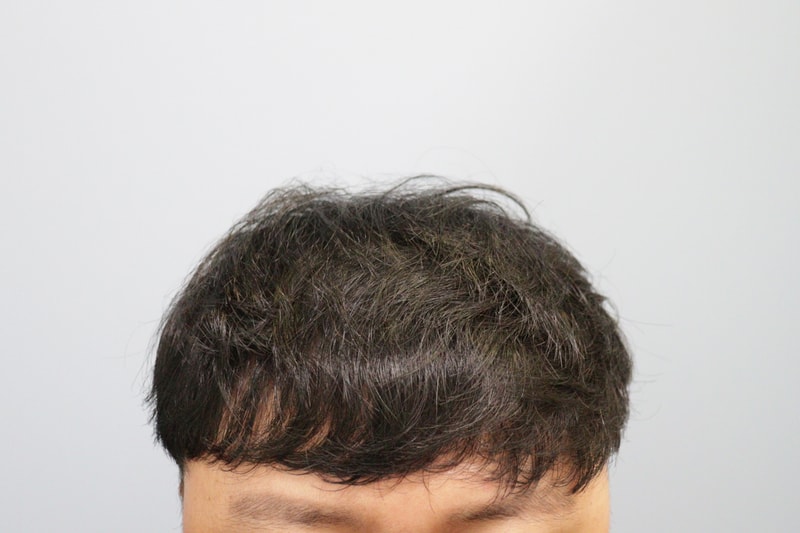 광주압구정모비앙의원 10개월경과후기