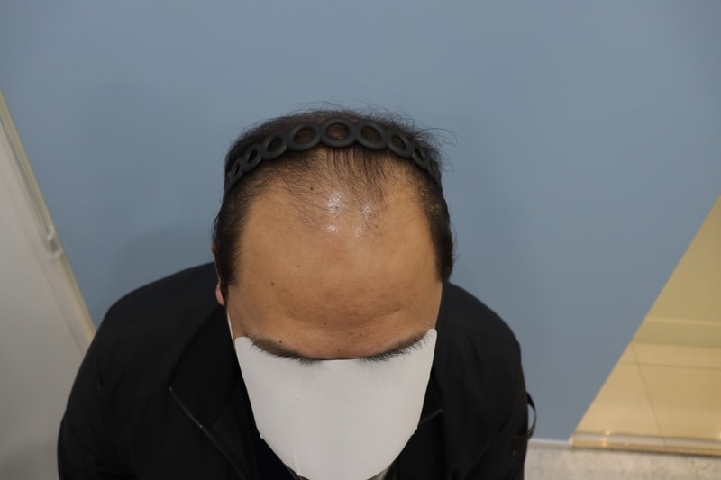 모발이식 365일 후 입니다.(만족 ㅎㅎ)