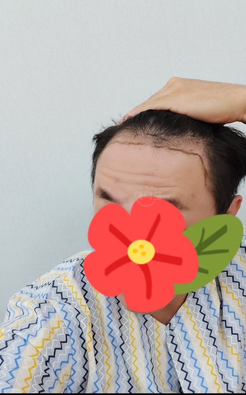 모디헤어플란트 3500모 비절개 9개월후기