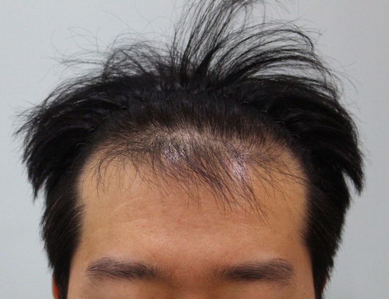 수술전 정면.jpg