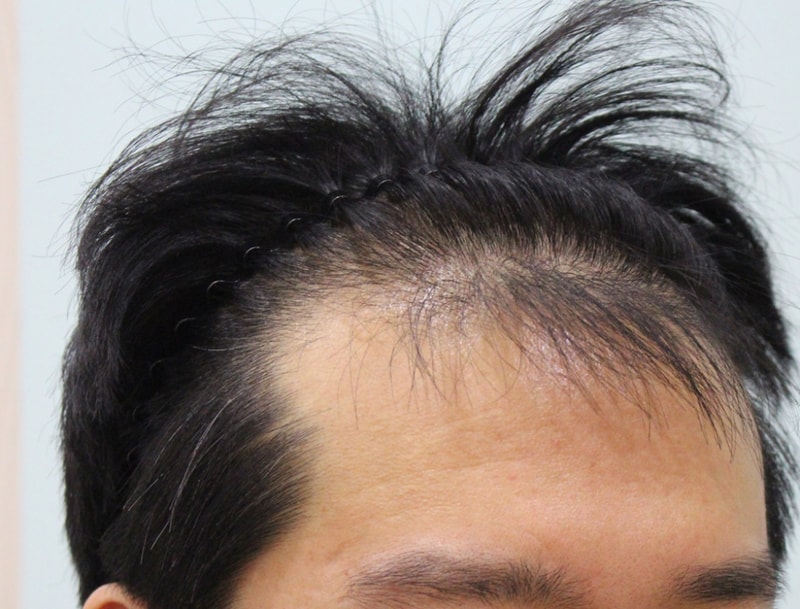 수술전 우측면.jpg
