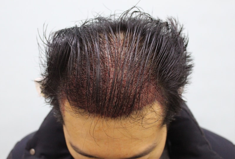 수술후 정수리.jpg