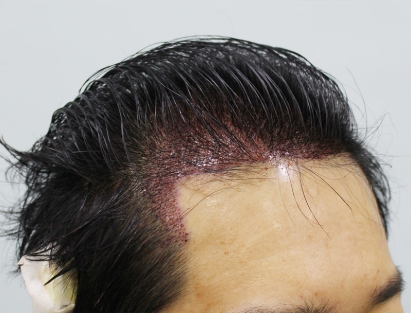 수술후 우측면.jpg