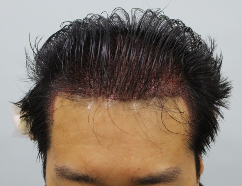 수술후 정면.jpg