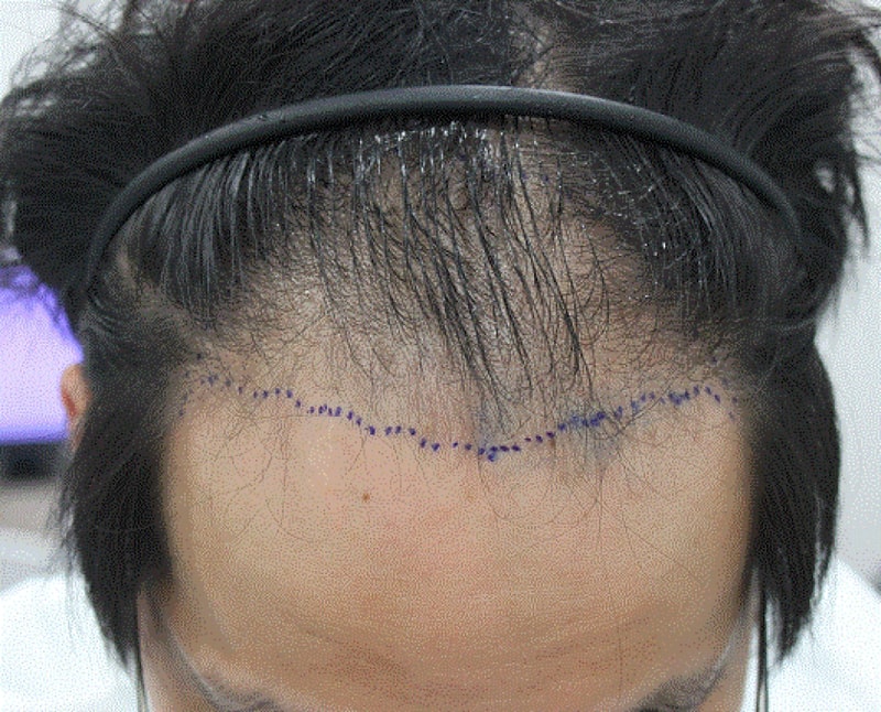 수술 사진 뒤늦게 올립니다.