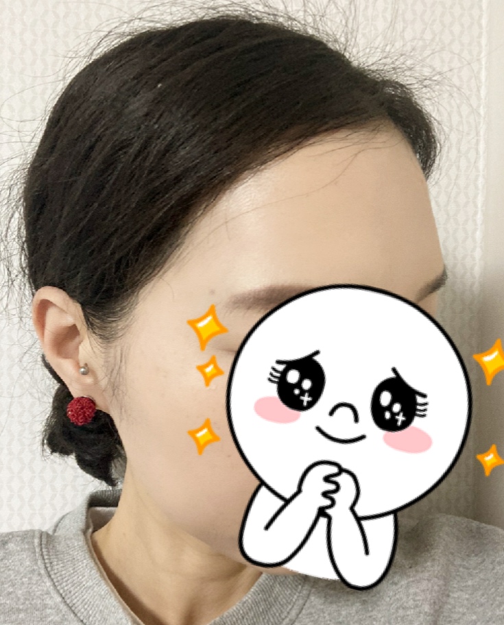 다나에서 수술했어요. 9개월~ + 두피문신 후기