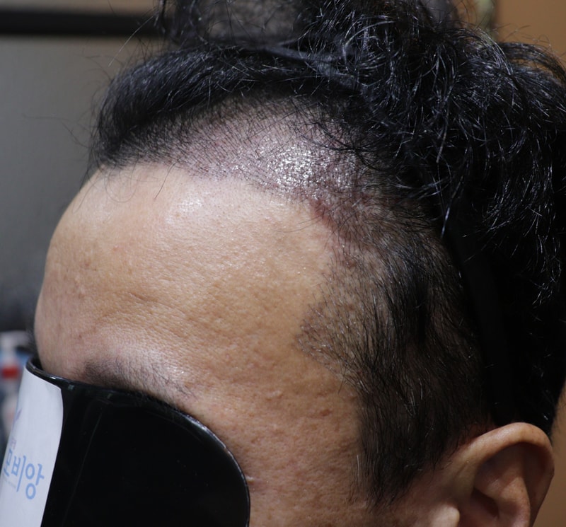 Review of the 10th day of the Hair Transplant of the Gwangju Apgujeong Mobiang member