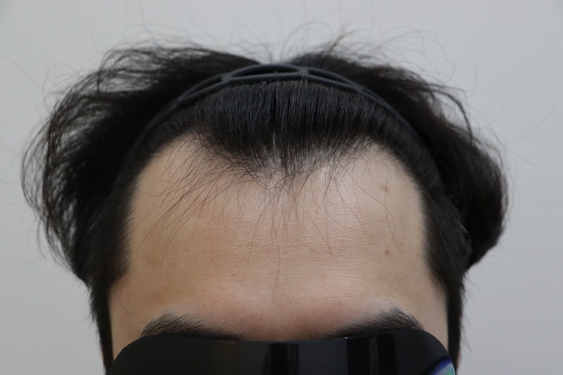 Two Weeks of Hair Transplantation at Apgujeong Mobiang Clinic in Gwangju