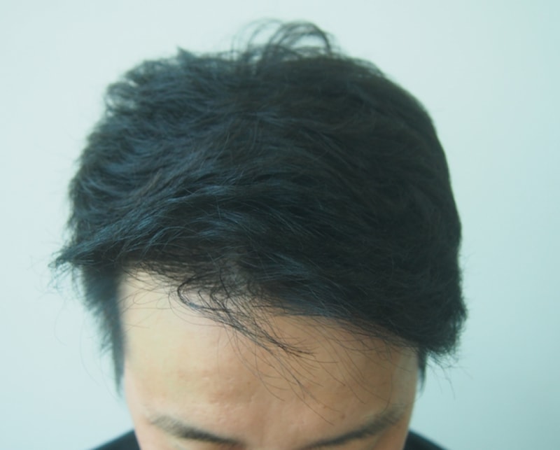 Non-cut 2500 hair follicles 13 months after photos