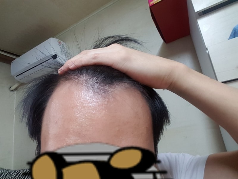 (비절개)엠자탈모 + 헤어라인 + 구렛나루 2000모낭